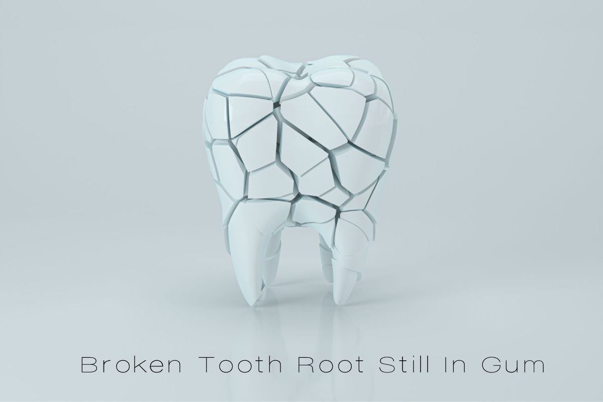 broken-tooth-root-still-in-gum-2023