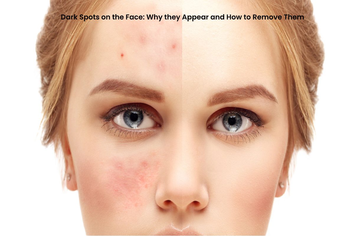 dark-spots-on-the-face-why-they-appear-and-how-to-remove-them