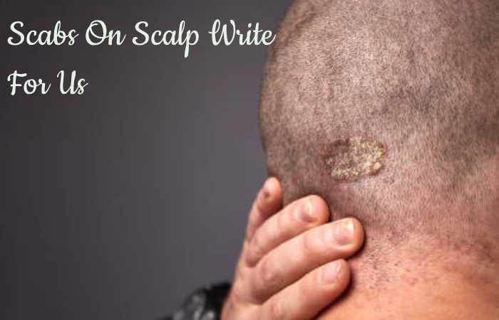 Scabs On Scalp Write For Us