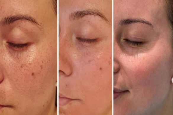 How the Cosmelan Peel Helps Treat Skin Discoloration and Restore Confidence